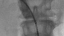 Cook Biliary biopsy forceps